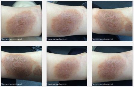 乾癬克服の写真記録６：乾癬のピーク（2014年9月前半）