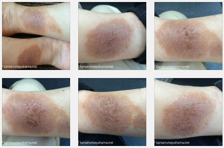乾癬克服の写真記録７：乾癬、ピークを越える（2014年9月後半）