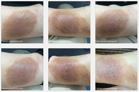 乾癬克服の写真記録８：乾癬、回復に向かう（2014年10月）