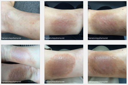 乾癬克服の写真記録９：乾癬、一進一退、そして現状（2014年11月～現在）